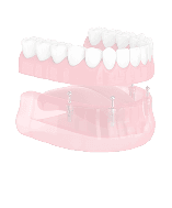 Имплантация всей челюсти в рассрочку